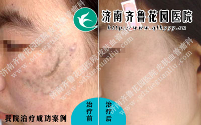 太田痣的发病严重影响患者的生活工作及社交,所以说针对太田痣的治疗是不可小视的,目前来说治疗太田痣最好的方法是采用激光治疗太田,那么效果如何呢。