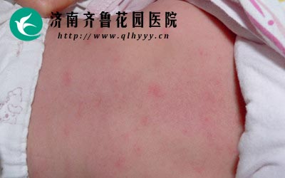 夏季使用凉席当心引发螨虫皮炎