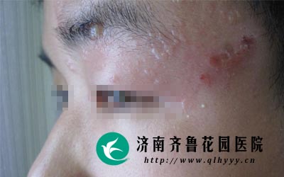 面部疱疹是有病毒感染所致有一定的传染性。