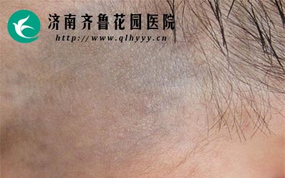 如果太田痣长在暴漏的皮肤上会严重影响美观。