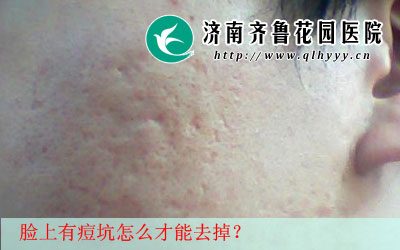 青春期阶段每个人脸上都会长有很多痘痘,在这个时候一旦处理不好就很容易留下痘坑,那么,痘坑能治好吗,痘坑的治疗方法是什么。