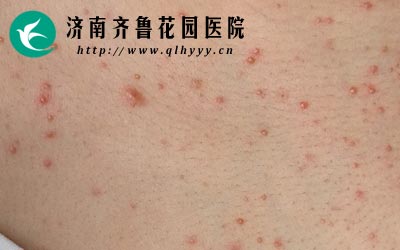 劣质脱毛膏会导致皮肤出现红肿或者脓包从而引发毛囊炎。