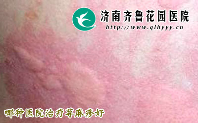 荨麻疹在急性发作期全身会出现瘙痒感,同时还会伴有大小形状不一的风团出现,那么,哪种医院治疗荨麻疹好,荨麻疹如何调理呢。