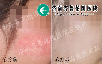 ����Ƥ��������ô�죬Ƥ�����������κ�����Ҫ��Ч��Ԥ������Ƥ��������������������һ��Ҫ�й����ԣ���֤�㹻��˯�ߺܹؼ���