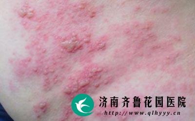 过度劳累或者抵抗力下降时就会引发带状疱疹。