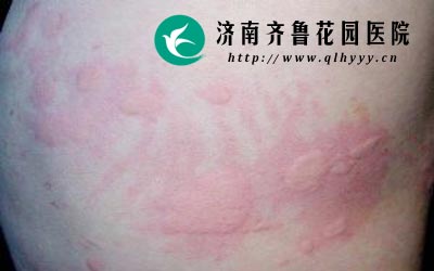 荨麻疹不具有遗传因素