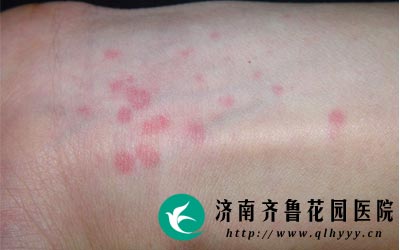 过敏性荨麻疹传染吗