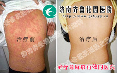 治疗荨麻疹有效的医院