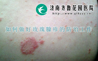 玫瑰糠疹应如何治疗呢