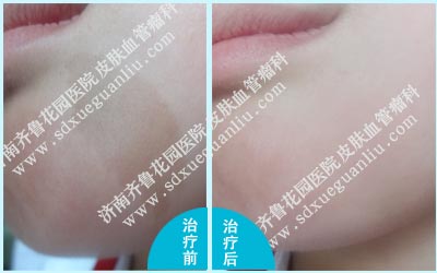 宝宝脸上的咖啡斑经过济南齐鲁花园医院治好后的前后图片对比