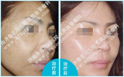 这位患者脸上的雀斑经过济南齐鲁花园医院治好后的前后图片对比