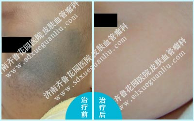 这位宝宝脸上的太田痣经过济南齐鲁花园医院治好后的前后图片对比