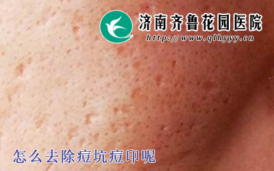 怎么去除痘坑痘印