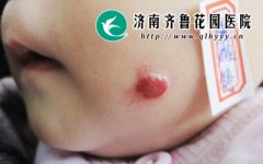 ����Ƥ���ϳ���С�����Ѫ������