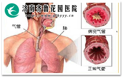 支气管炎医院排名_支气管炎医院证明(2)