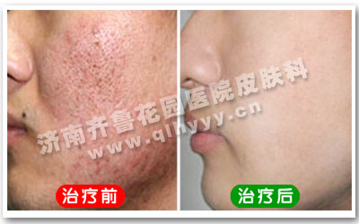 刘先生脸上的痘印治疗前后对比图