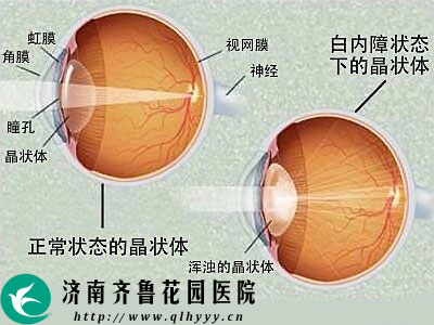老年人白内障是什么原因 20-160530095150W1.jpg