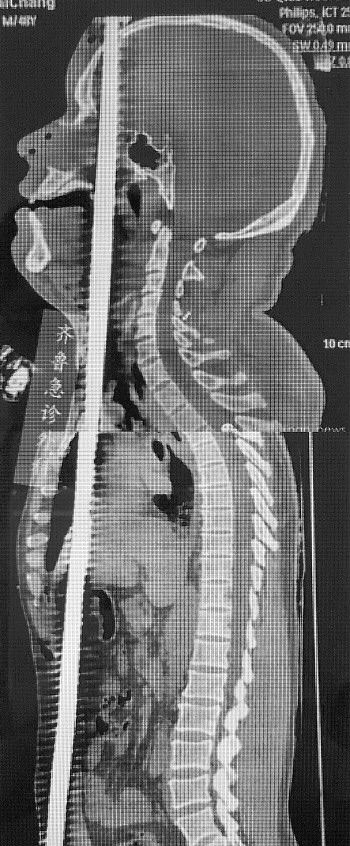 ³ҽԺεĸֽᴩ廼CTͼ