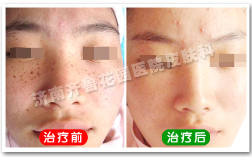 我院治疗雀斑康复案例