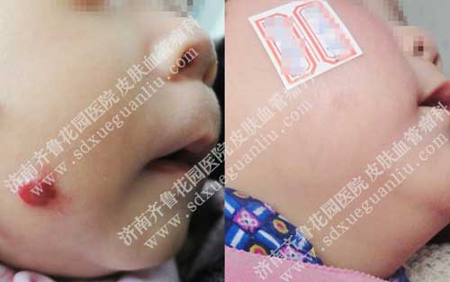 ³԰ҽԺƤѪƶӤ׶沿ѪǰԱͼ