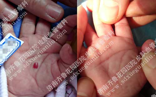 ³԰ҽԺƤѪƶӤ׶ѪǰԱͼ