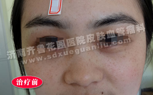面部雀斑患者治疗前的照片