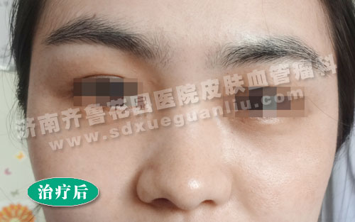 面部雀斑患者治疗后的照