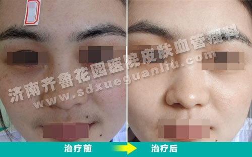 面部雀斑患者经我院皮肤科专家治疗前后对比照片