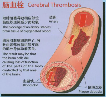 脑血栓的发病原因及饮食禁忌_济南齐鲁花园医院