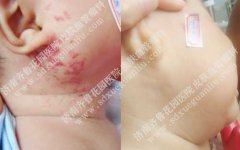 什么原因会引起血管瘤 20-161202103604K9-lp.jpg