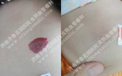 宫颈管有病变怎么处理 20-1F310145924P6-lp.jpg