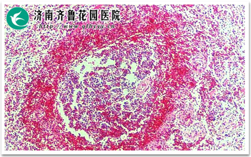 腿上局部皮肤出现红肿红疹是丹毒怎么护理才行_济南齐鲁花园医院