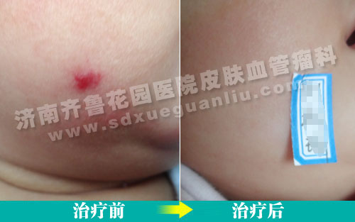 患儿面部混合型血管瘤经四联吸融疗法治疗前后对比照片
