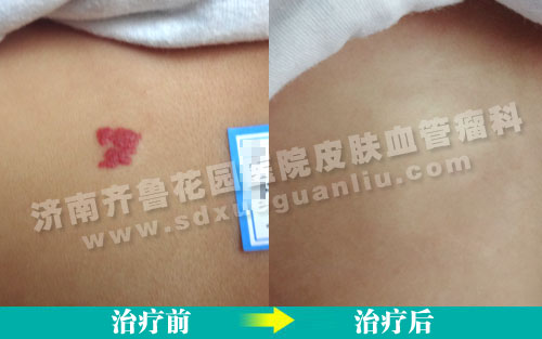 患儿背部草莓状血管瘤经四联吸融疗法治疗前后对比照片
