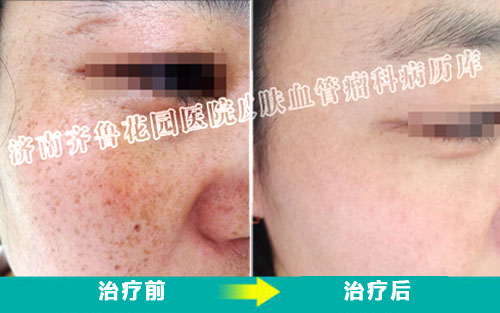 调Q智能治疗仪联合药物才是治疗雀斑的最好方法