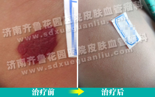 患儿左侧背部血管瘤经四联吸融疗法治疗前后对比照片