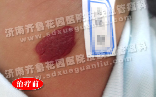 怎么治宝宝左侧腰背部高出皮肤的红色斑块好