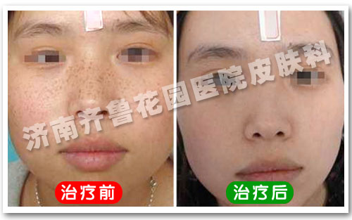 雀斑患者经多联阶梯疗法治疗前后对比照片