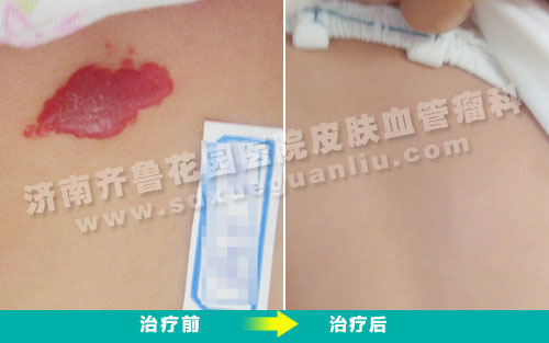 后背血管瘤患儿经四联吸融疗法治疗前后对比照片