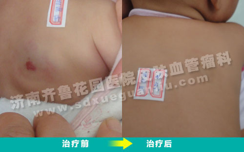 后背血管瘤患儿经四联吸融疗法治疗前后对比照片