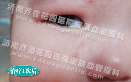 怎么去除眼睛下面斑 14-1PF415350N50.jpg
