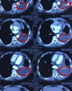 ɽʡҽԺǻ»ʯĤ̶Ϊΰ߻ⲡʹ