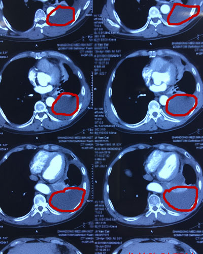 山东省立第三医院用胸腔镜下滑石粉胸膜固定术为肺癌患者缓解病痛