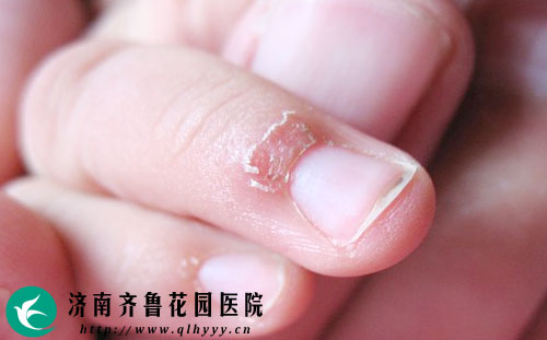 宝宝手指长倒刺是什么原因_济南齐鲁花园医院