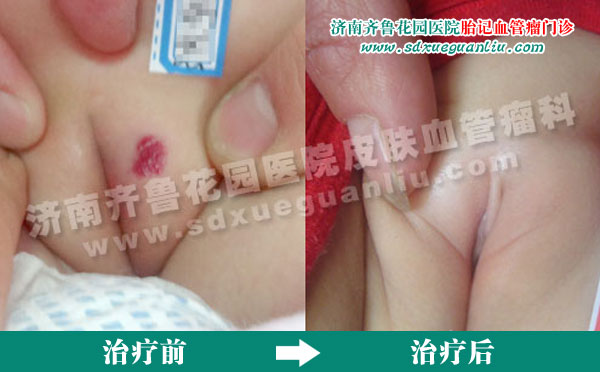 四联吸融疗法能有效祛除血管瘤