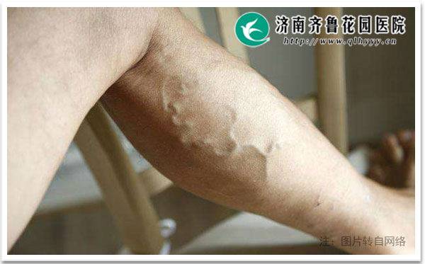 腿上弯弯曲的粗血管是静脉曲张不治自己能好吗