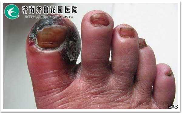 身上热毒的症状 14-1Z11GA35I58.jpg