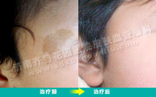 咖啡斑和雀斑样痣哪个好治