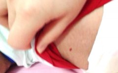 背上的小红点没变大到底是否要去医院看诊