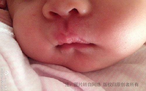 出生的时候人中和鼻头的位置就有红斑